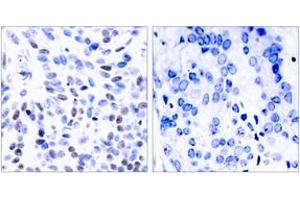 Immunohistochemistry analysis of paraffin-embedded human breast carcinoma tissue, using NF-kappaB p100/p52 (Ab-865) Antibody. (NFKB2 anticorps  (AA 833-882))
