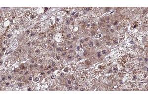 ABIN6277456 at 1/100 staining Human liver cancer tissue by IHC-P. (SCTR anticorps  (Internal Region))