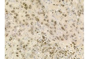 ABIN6258445 and ABIN6275688 at 1/100 staining human melanoma by IHC-P.