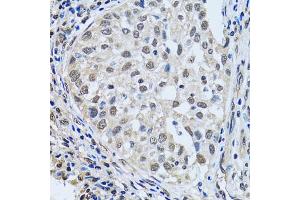 Immunohistochemistry of paraffin-embedded human lung cancer using LSM4 antibody (ABIN5973492) at dilution of 1/100 (40x lens). (LSM4 anticorps)