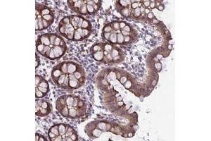 Immunohistochemical staining of human colon with FAM125A polyclonal antibody  shows moderate cytoplasmic and membranous positivity in glandular cells at 1:50-1:200 dilution. (FAM125A anticorps)