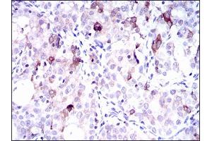 Immunohistochemical analysis of paraffin-embedded cervical cancer tissues using SLC27A5 mouse mAb with DAB staining. (SLC27A5 anticorps  (AA 508-570))