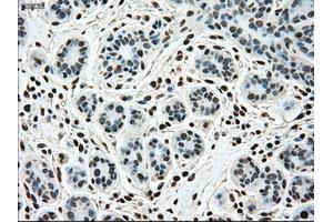 Immunohistochemical staining of paraffin-embedded breast tissue using anti-SSB mouse monoclonal antibody. (SSB anticorps)