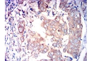 Immunohistochemical analysis of paraffin-embedded breast cancer tissues using FAP mouse mAb with DAB staining.