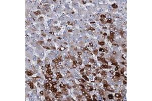 Immunohistochemical staining of human liver with C1orf68 polyclonal antibody  shows strong cytoplasmic positivity in subset of hepatocytes at 1:50-1:200 dilution. (C1orf68 anticorps)