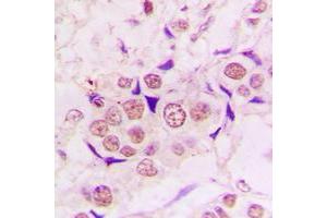 Immunohistochemical analysis of ZC3H8 staining in human lung cancer formalin fixed paraffin embedded tissue section.