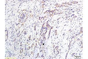 Formalin-fixed and paraffin embedded human pancreatic cancer labeled with Anti-EDG2/LPA1 Polyclonal Antibody, Unconjugated (ABIN681103) at 1:400 followed by conjugation to the secondary antibody and DAB staining (LPAR1 anticorps  (AA 281-364))