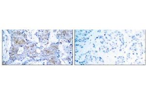 Immunohistochemical analysis of paraffin- embedded human breast carcinoma tissue using HER2 (Ab-1248) antibody (E021072). (ErbB2/Her2 anticorps)