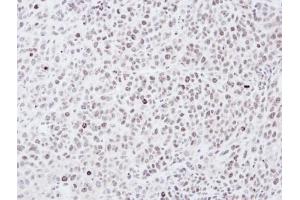 IHC-P Image Immunohistochemical analysis of paraffin-embedded SCM-1 xenograft, using Chk1, antibody at 1:100 dilution. (CHEK1 anticorps)