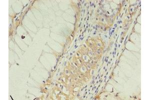 Immunohistochemistry of paraffin-embedded human colon cancer using ABIN7147867 at dilution of 1:100