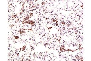 Formalin-fixed and paraffin embedded human lung carcinoma labeled with Anti-Dnmt1 Polyclonal Antibody, Unconjugated  at 1:200, followed by conjugation to the secondary antibody and DAB staining
