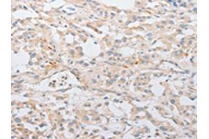 The image on the left is immunohistochemistry of paraffin-embedded Human thyroid cancer tissue using ABIN7131038(SERPINE2 Antibody) at dilution 1/20, on the right is treated with fusion protein.