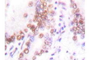 Immunohistochemistry analysis with EP300 / P300 antibody in paraffin-embedded human lung carcinoma tissue. (p300 anticorps)