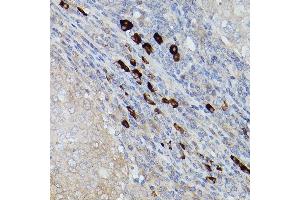 Immunohistochemistry of paraffin-embedded human breast cancer using UBE2L6 Rabbit pAb (ABIN1683197, ABIN3018773, ABIN3018774 and ABIN7101658) at dilution of 1:250 (40x lens). (UBE2L6 anticorps)