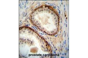 NUDT8 antibody immunohistochemistry analysis in formalin fixed and paraffin embedded human prostate carcinoma followed by peroxidase conjugation of the secondary antibody and DAB staining. (NUDT8 anticorps  (N-Term))