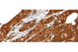 Immunohistochemistry of paraffin-embedded Human breast cancer tissue using LIPG Polyclonal Antibody at dilution of 1:50(x200) (LIPG anticorps)