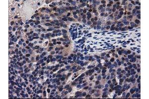Immunohistochemical staining of paraffin-embedded Carcinoma of Human kidney tissue using anti-ADSL mouse monoclonal antibody.