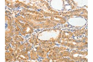 The image on the left is immunohistochemistry of paraffin-embedded Human thyroid cancer tissue using ABIN7189848(APOB Antibody) at dilution 1/10, on the right is treated with synthetic peptide. (APOB anticorps)
