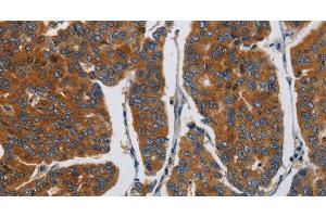 Immunohistochemistry of paraffin-embedded Human breast cancer using APEH Polyclonal Antibody at dilution of 1:30 (APEH anticorps)