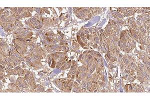 ABIN6268679 at 1/100 staining Human Melanoma tissue by IHC-P.