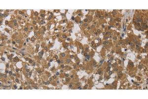 Immunohistochemistry of paraffin-embedded Human thyroid cancer using Cytochrome b5 Polyclonal Antibody at dilution of 1:40