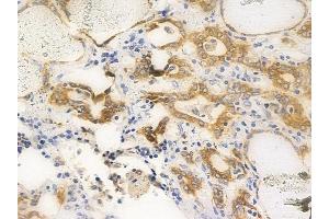 ABIN6256416 and ABIN6267653 at 1/100 staining human thyroid carcinoma by IHC-P. (PKD1/2/3/PKC mu (pSer738), (pSer742) anticorps)