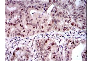 Immunohistochemical analysis of paraffin-embedded rectum cancer tissues using KID mouse mAb with DAB staining.