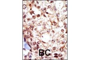 Formalin-fixed and paraffin-embedded human cancer tissue reacted with the primary antibody, which was peroxidase-conjugated to the secondary antibody, followed by AEC staining.