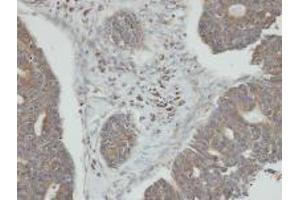 Immunohistochemistry: PP2C kappa/PPM1K antibody staining of Paraffin-Embedded endo mitral OVCA at 1/100 dilution. (PPM1K anticorps  (N-Term))