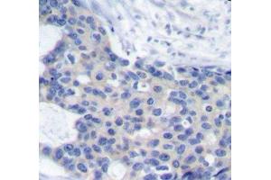 Immunohistochemistry of paraffin-embedded Human breast carcinoma tissue, using Phospho-ZAP70(Y493) Polyclonal Antibody