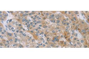 Immunohistochemistry of paraffin-embedded Human liver cancer tissue using ZAK Polyclonal Antibody at dilution of 1:100(x200)