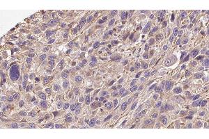 ABIN6272277 at 1/100 staining Human Melanoma tissue by IHC-P. (COL19A1 anticorps)