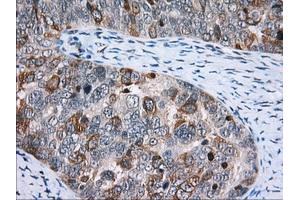 Immunohistochemical staining of paraffin-embedded Adenocarcinoma of Human colon tissue using anti-CD5 mouse monoclonal antibody. (CD5 anticorps)