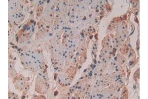 Detection of VAV3 in Human Esophagus cancer Tissue using Polyclonal Antibody to Vav 3 Oncogene (VAV3)