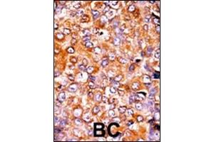 Formalin-fixed and paraffin-embedded human cancer tissue reacted with the primary antibody, which was peroxidase-conjugated to the secondary antibody, followed by AEC staining.