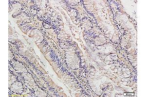 Formalin-fixed and paraffin embedded human colon cancer labeled with Anti-IDE Polyclonal Antibody, Unconjugated (ABIN723680) at 1:300, followed by conjugation to the secondary antibody and DAB staining