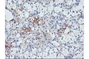 Immunohistochemical staining of paraffin-embedded Carcinoma of Human kidney tissue using anti-SERPINE2 mouse monoclonal antibody. (SERPINE2 anticorps)