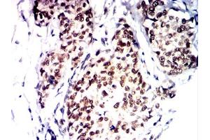 Immunohistochemical analysis of paraffin-embedded bladder cancer tissues using PMS2 mouse mAb with DAB staining.