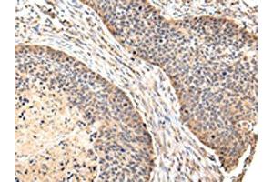 The image on the left is immunohistochemistry of paraffin-embedded Human esophagus cancer tissue using ABIN7128081(VIL1 Antibody) at dilution 1/30, on the right is treated with fusion protein. (Villin 1 anticorps)