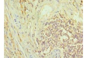 Immunohistochemistry of paraffin-embedded human colon cancer using ABIN7149352 at dilution of 1:100 (NCK1 anticorps  (AA 58-377))