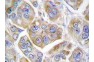 Immunohistochemistry analyzes of Integrin β4 antibody in paraffin-embedded human breast carcinoma tissue. (Integrin beta 4 anticorps)