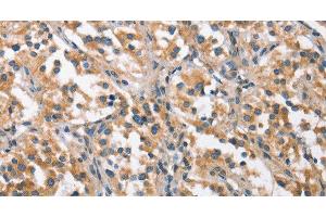 Immunohistochemistry of paraffin-embedded Human thyroid cancer using CHMP1A Polyclonal Antibody at dilution of 1:60 (CHMP1A anticorps)