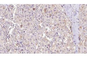 ABIN6273314 at 1/100 staining Human thyroid cancer tissue by IHC-P. (EXOC3 anticorps  (Internal Region))