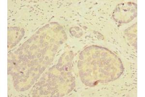 Immunohistochemistry of paraffin-embedded human gastric cancer using ABIN7171988 at dilution of 1:100 (THTPA anticorps  (AA 2-230))