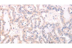 Immunohistochemistry of paraffin-embedded Human thyroid cancer using TRAF3IP1 Polyclonal Antibody at dilution of 1:70 (TRAF3IP1 anticorps)