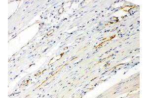 ANGPTL2 was detected in paraffin-embedded sections of human intetsinal cancer tissues using rabbit anti- ANGPTL2 Antigen Affinity purified polyclonal antibody (Catalog # ) at 1 µg/mL.