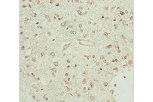 Immunohistochemistry of paraffin-embedded human glioma using ABIN7159847 at dilution of 1:100 (BCS1L anticorps  (AA 33-240))