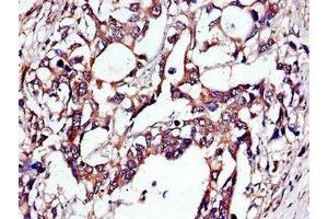 Immunohistochemistry of paraffin-embedded human gastric cancer using ABIN7173671 at dilution of 1:100 (TUBA4A anticorps  (AA 20-183))