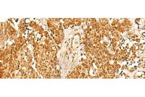 Immunohistochemistry of paraffin-embedded Human lung cancer tissue using SSSCA1 Polyclonal Antibody at dilution of 1:50(x200) (SSSCA1 anticorps)