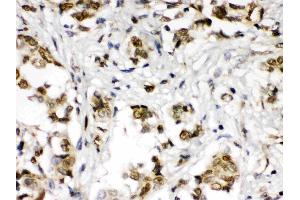 ABR was detected in paraffin-embedded sections of human mammary cancer tissues using rabbit anti- ABR Antigen Affinity purified polyclonal antibody (Catalog # ) at 1 ? (ABR anticorps  (Middle Region))